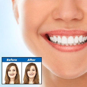 Instant Smile Comfort Veneer-Beauty-Thechoiceday.com-TheChoiceDay.com