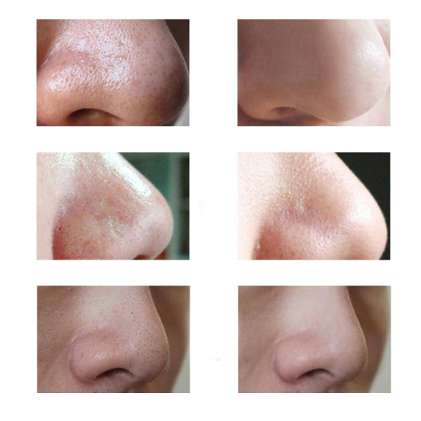 Comedo Suction Blackhead Remover